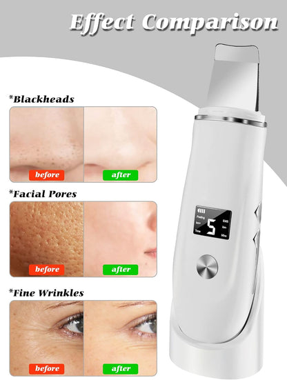 Ultrasonic Facial Skin Scrubber - Deep Cleansing & Blackhead Remover Spatula