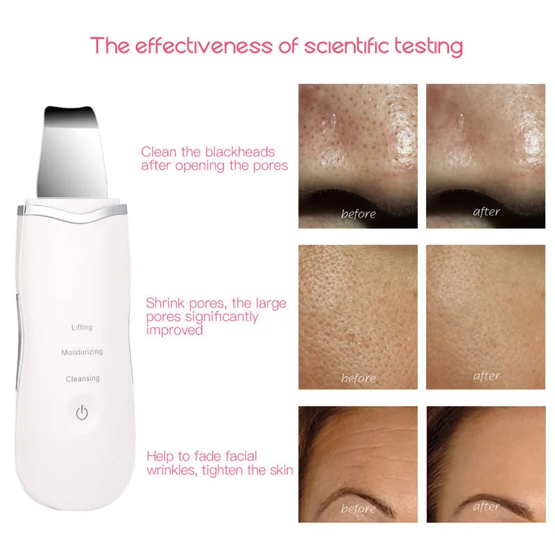 3-in-1 Ultrasonic Skin Scrubber & Facial Deep Cleansing Spatula Tool - 8