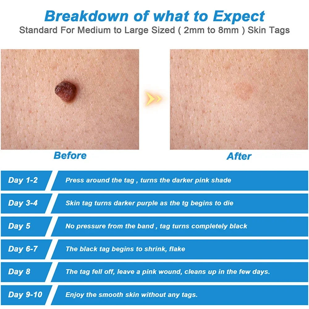2-in-1 Skin Tag Removal Kit - Painless Home Mole & Skin Tag Remover Tool