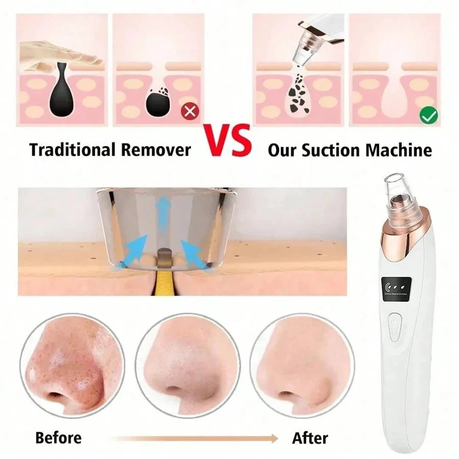Electric Blackhead Remover & Pore Vacuum Deep Cleansing Device - 2