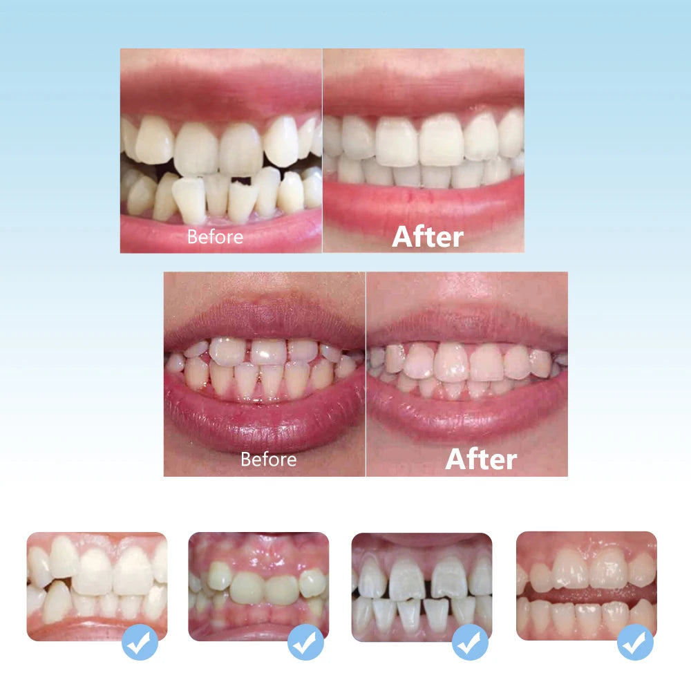 3-Stage Dental Orthodontic Alignment Trainer for Kids Teeth Straightening - 7