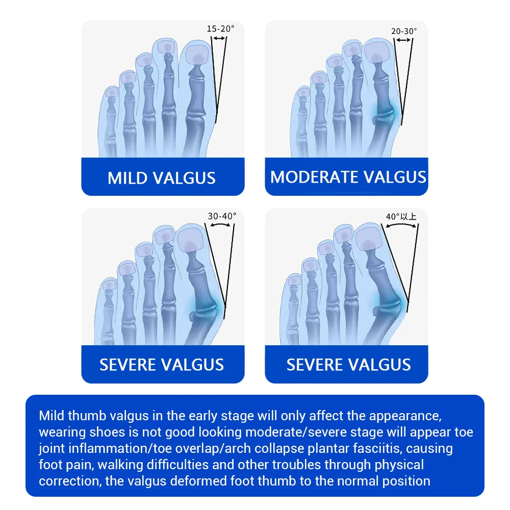 Adjustable Bunion Corrector & Big Toe Straightener for Pain Relief - 5