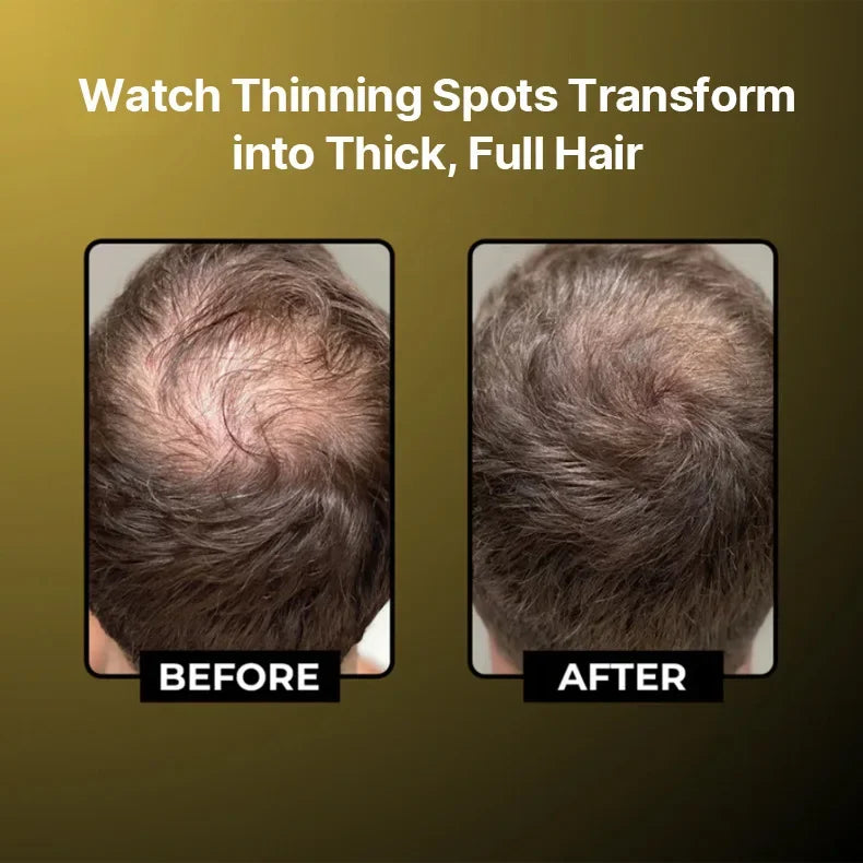 Microneedle Hair Regrowth Serum Kit - Scalp Nourishing & Micro-Infusion Treatment - 2