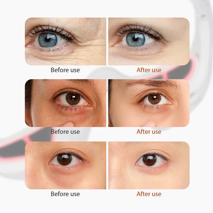 EMS Red Light Therapy Under Eye Massager for Wrinkles & Dark Circles