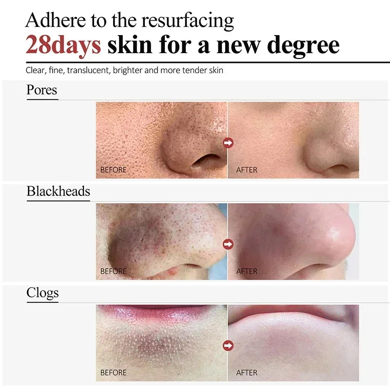 Salicylic Acid Pore Refining Cream - Acne Scar & Blackhead Treatment