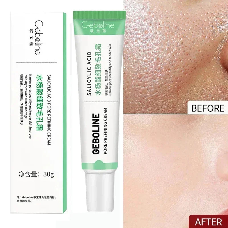 Salicylic Acid Pore Refining Cream - Acne Scar & Blackhead Treatment