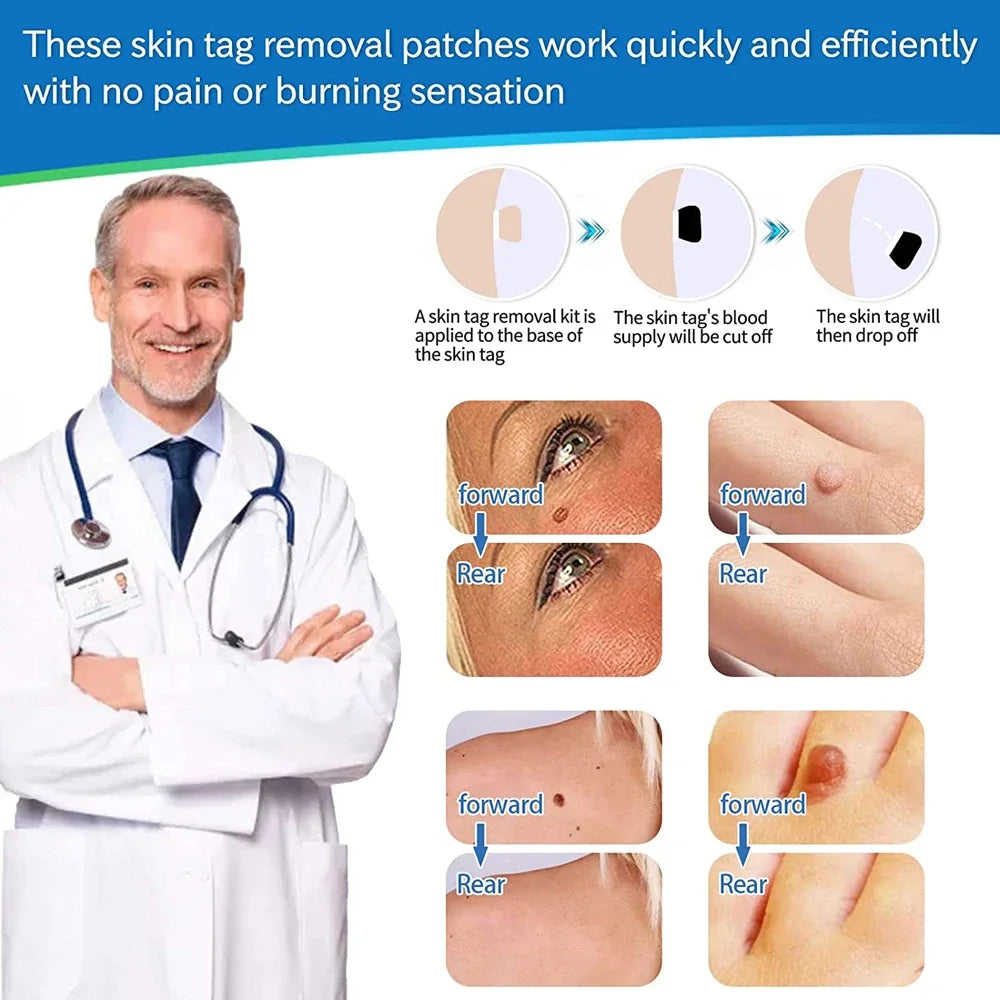 2-in-1 Skin Tag Removal Kit - Painless Home Mole & Skin Tag Remover Tool - 11