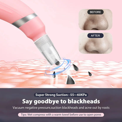 2-in-1 Microdermabrasion Facial Device & Blackhead Vacuum