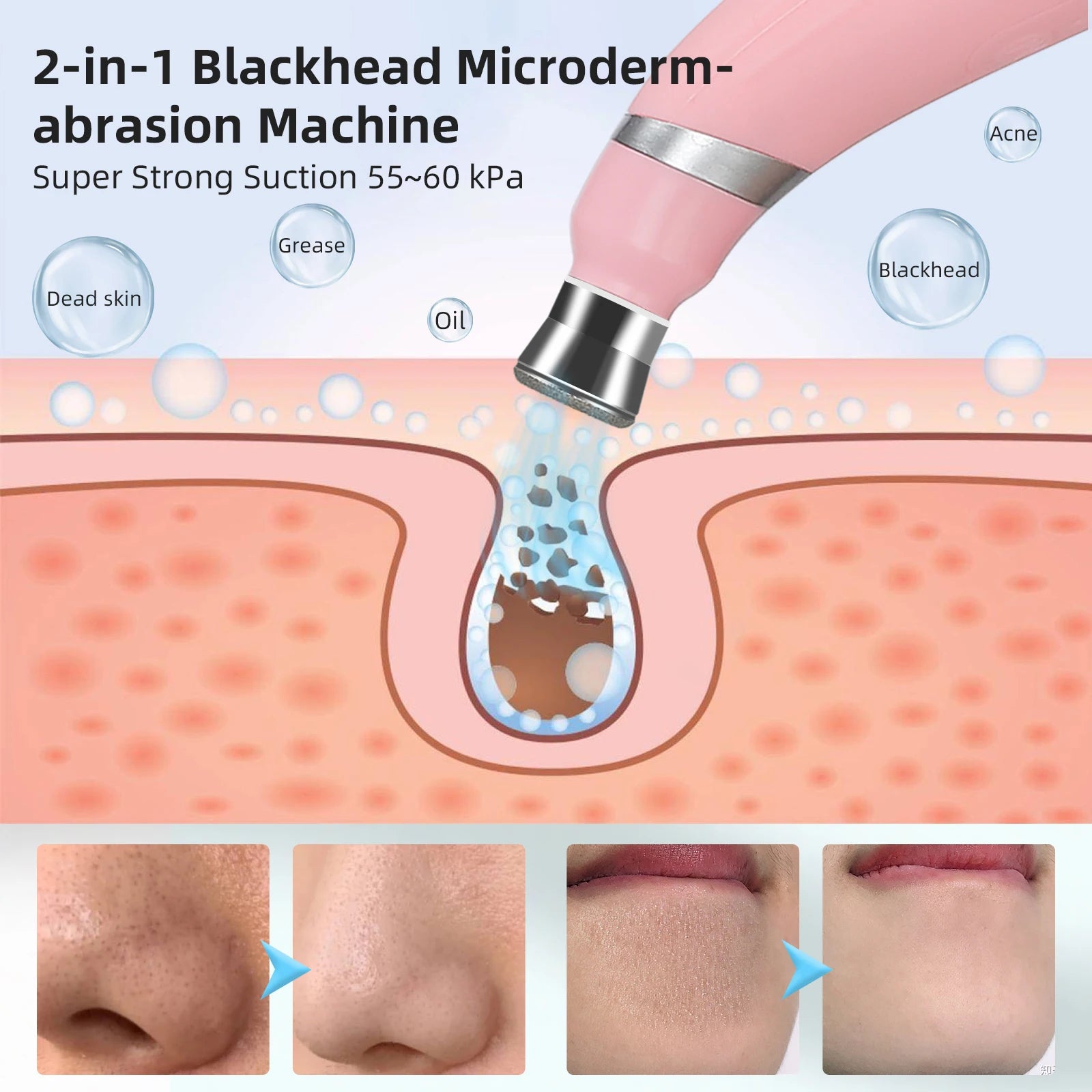 2-in-1 Microdermabrasion Facial Device & Blackhead Vacuum - 4
