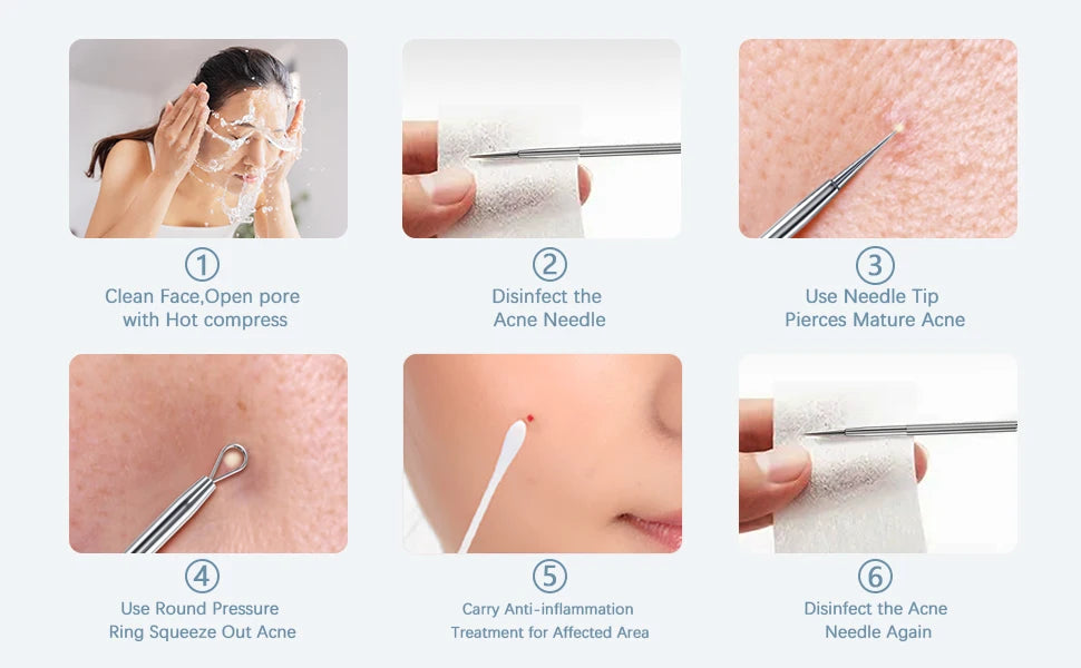 Professional Stainless Steel Blackhead Extractor & Pimple Popper Tool Kit