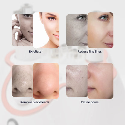 Professional 3-in-1 Diamond Microdermabrasion Facial Machine