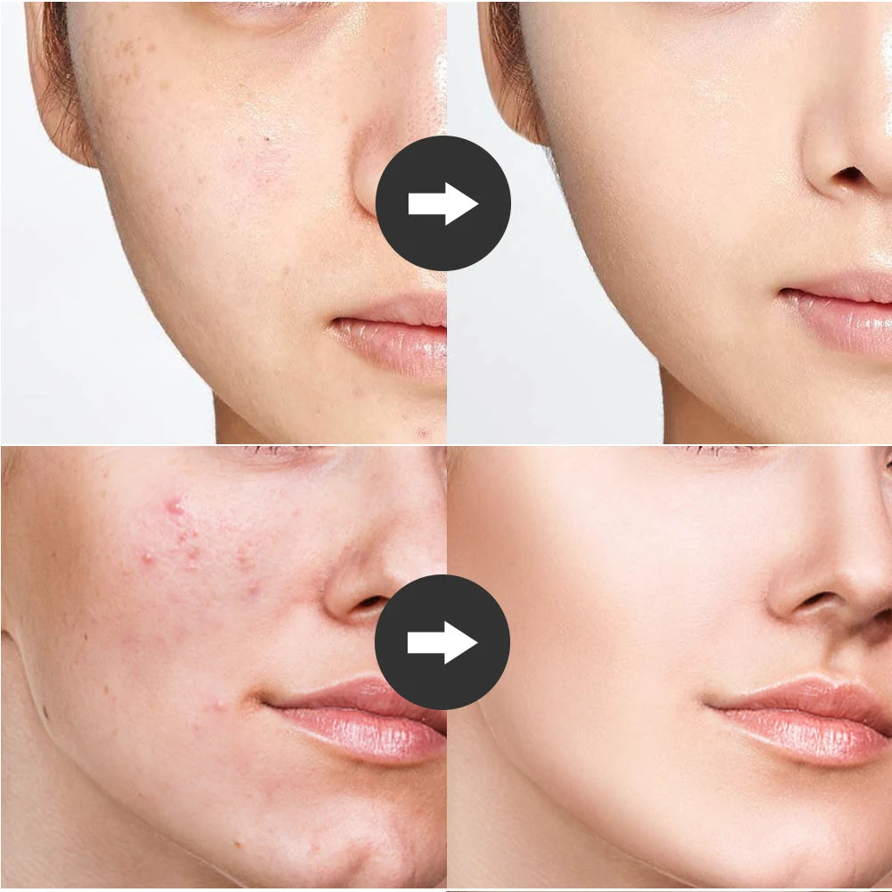 4-in-1 High Frequency Facial Therapy Wand for Acne