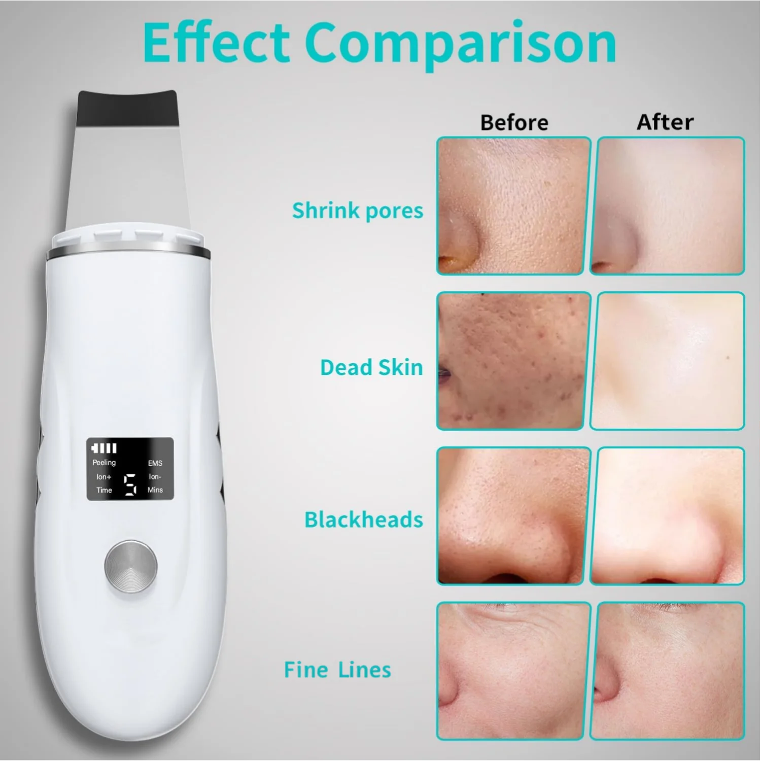 Ultrasonic Facial Skin Scrubber - Deep Cleansing & Blackhead Remover Spatula - 3