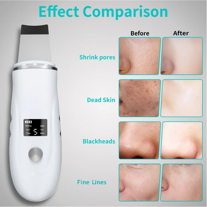 Ultrasonic Facial Skin Scrubber - Deep Cleansing & Blackhead Remover Spatula