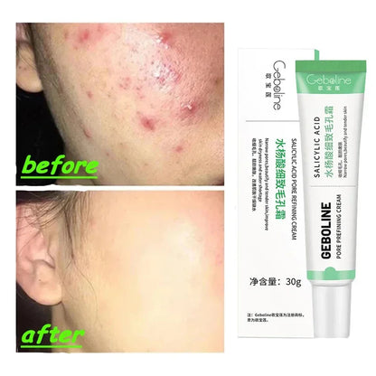 Salicylic Acid Pore Refining Cream - Acne Scar & Blackhead Treatment