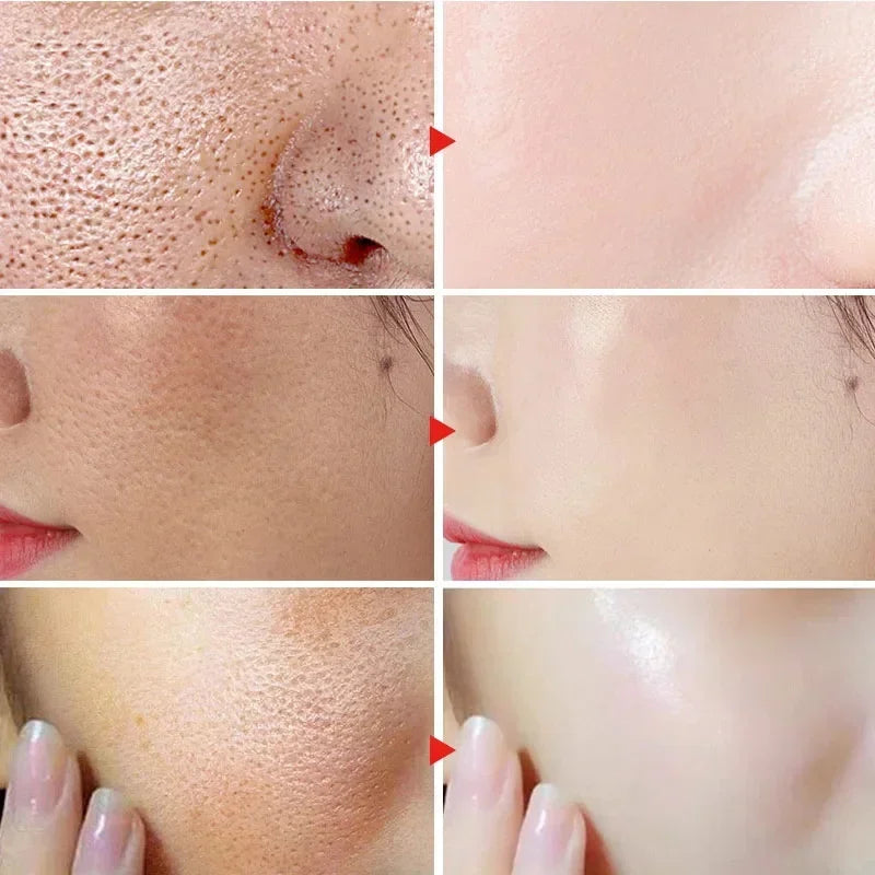 Salicylic Acid Pore Refining Cream - Acne Scar & Blackhead Treatment - 12