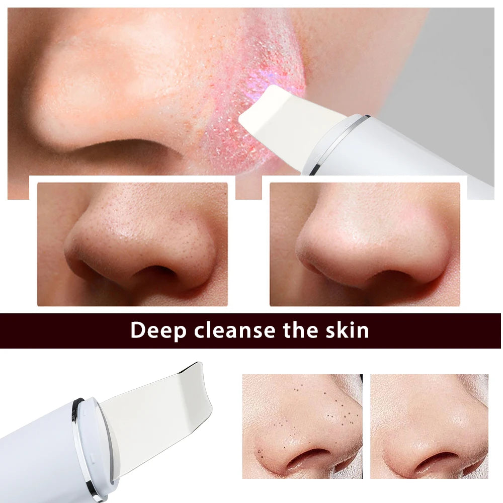 Ultrasonic Facial Skin Scrubber - Deep Pore Cleansing & Lifting Spatula Device