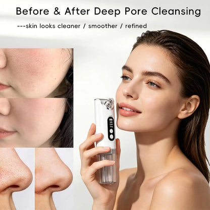 Electric Pore Vacuum Blackhead Remover with Hydration & Suction Facial Cleansing