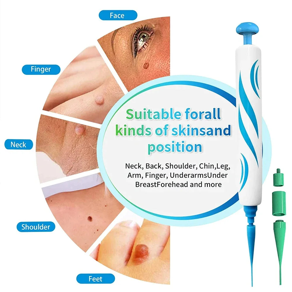 2-in-1 Skin Tag Removal Kit - Painless Home Mole & Skin Tag Remover Tool - 3