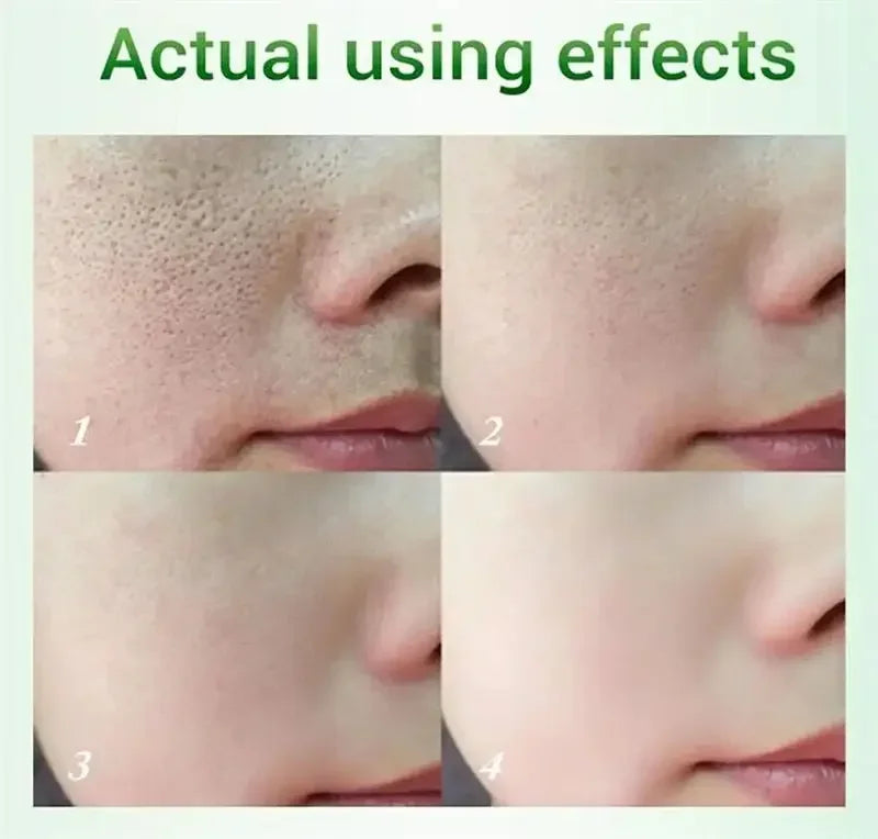 Salicylic Acid Pore Refining Cream - Acne Scar & Blackhead Treatment - 8