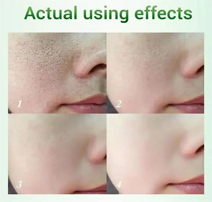 Salicylic Acid Pore Refining Cream - Acne Scar & Blackhead Treatment
