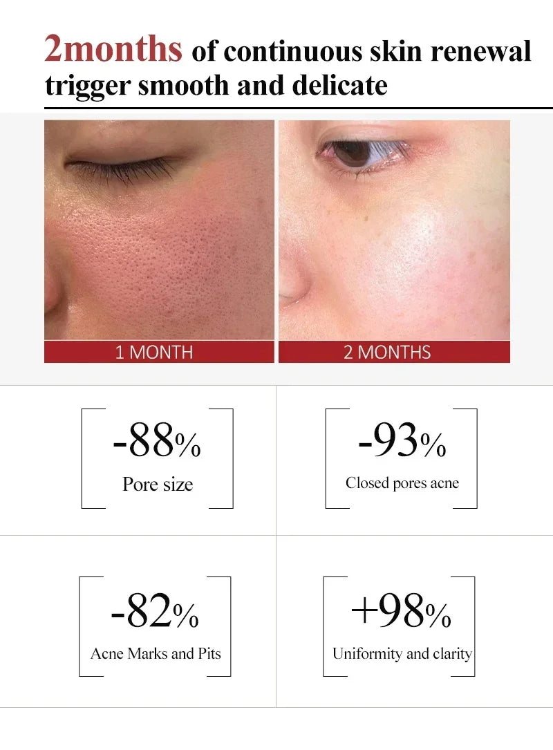 Salicylic Acid Pore Refining Cream - Acne Scar & Blackhead Treatment
