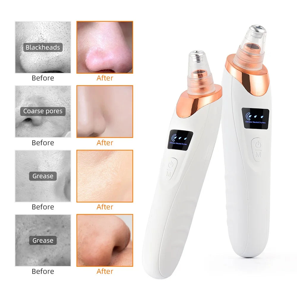 Electric Vacuum Blackhead Remover & Facial Pore Cleanser