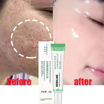 Salicylic Acid Pore Refining Cream - Acne Scar & Blackhead Treatment