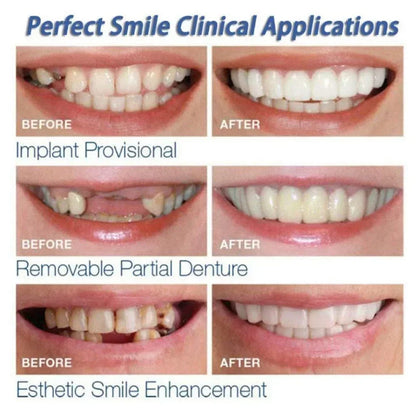 Snap-On Smile Veneers Kit – Instant Temporary Teeth Whitening & Cosmetic Cover