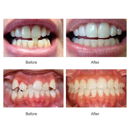 3-Stage Dental Teeth Trainer & Orthodontic Alignment Braces for Adults