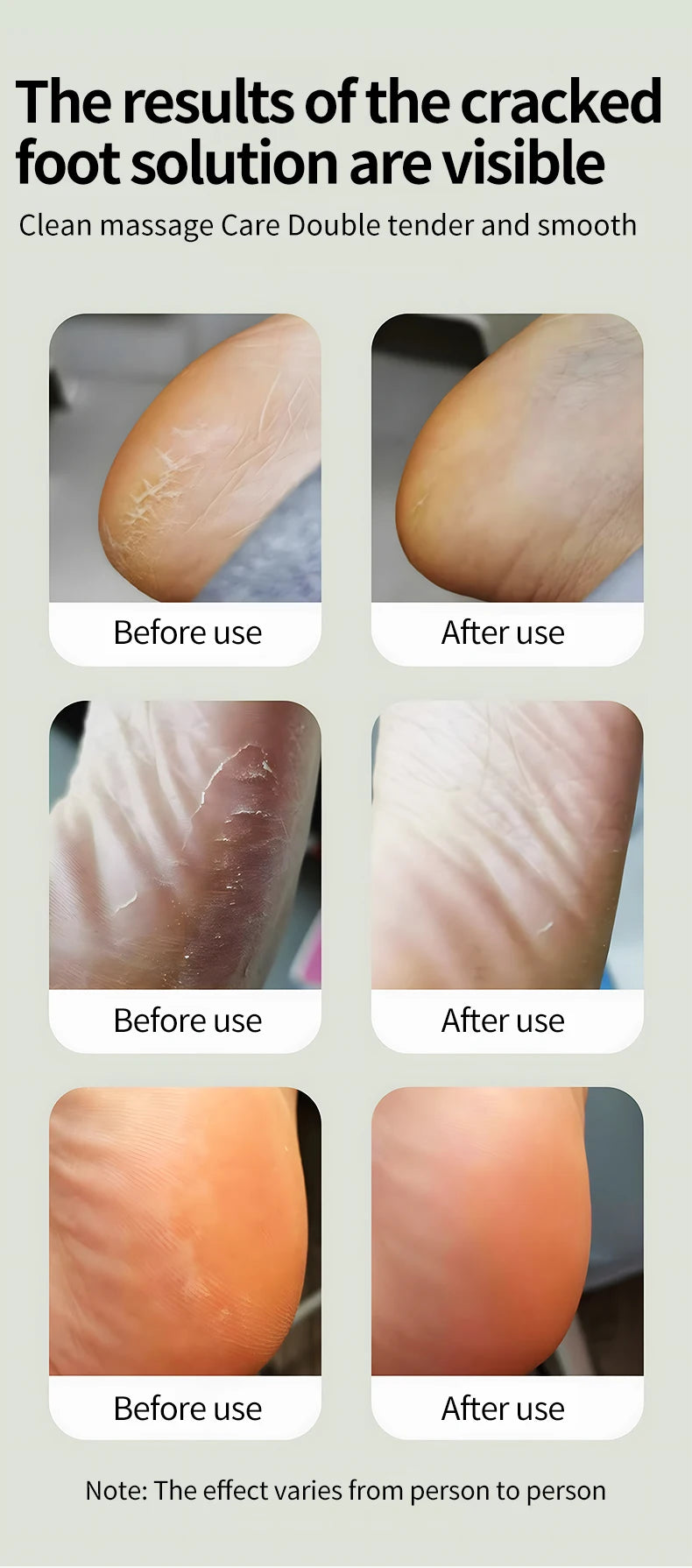 Electric Foot Callus Remover - Professional Cordless Pedicure Tool for Smooth Feet