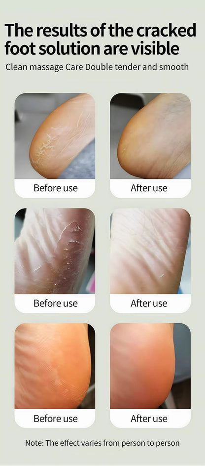 Electric Foot Callus Remover - Professional Cordless Pedicure Tool for Smooth Feet