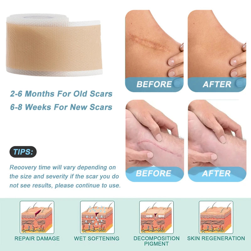 Silicone Scar Removal Tape - Waterproof, Reusable Adhesive Gel Sheet for Scar Repair