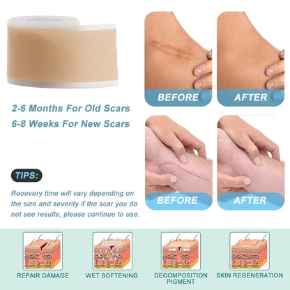 Silicone Scar Removal Tape - Waterproof, Reusable Adhesive Gel Sheet for Scar Repair