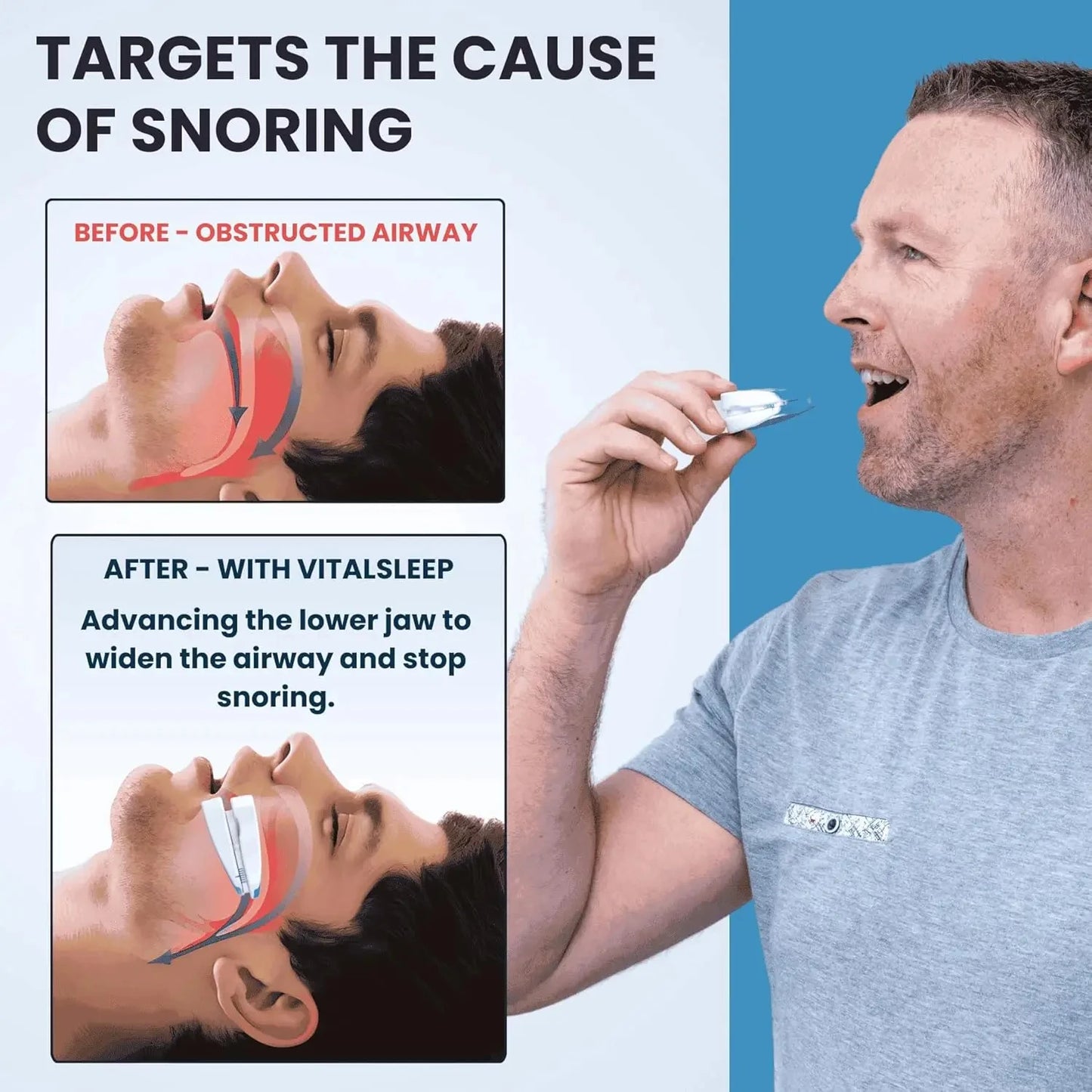 Adjustable Anti-Snoring Mouth Guard Sleep Mouthpiece for Bruxism & Snoring Relief